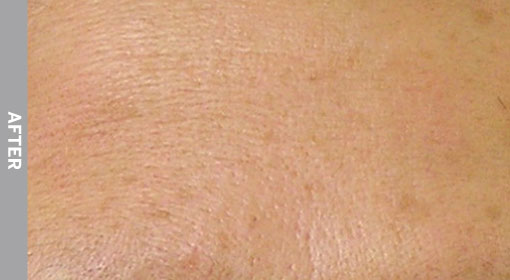 Fine-Lines-And-Wrinkles-After