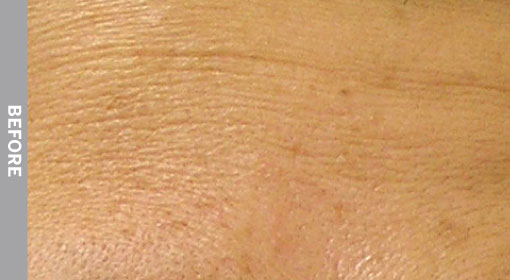 Fine-Lines-And-Wrinkles-Before