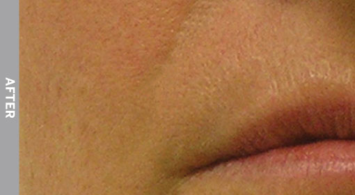 Nasolabial-Folds-After