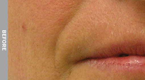 Nasolabial-Folds-Before