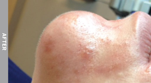 Oily-And-Congested-Skin-After