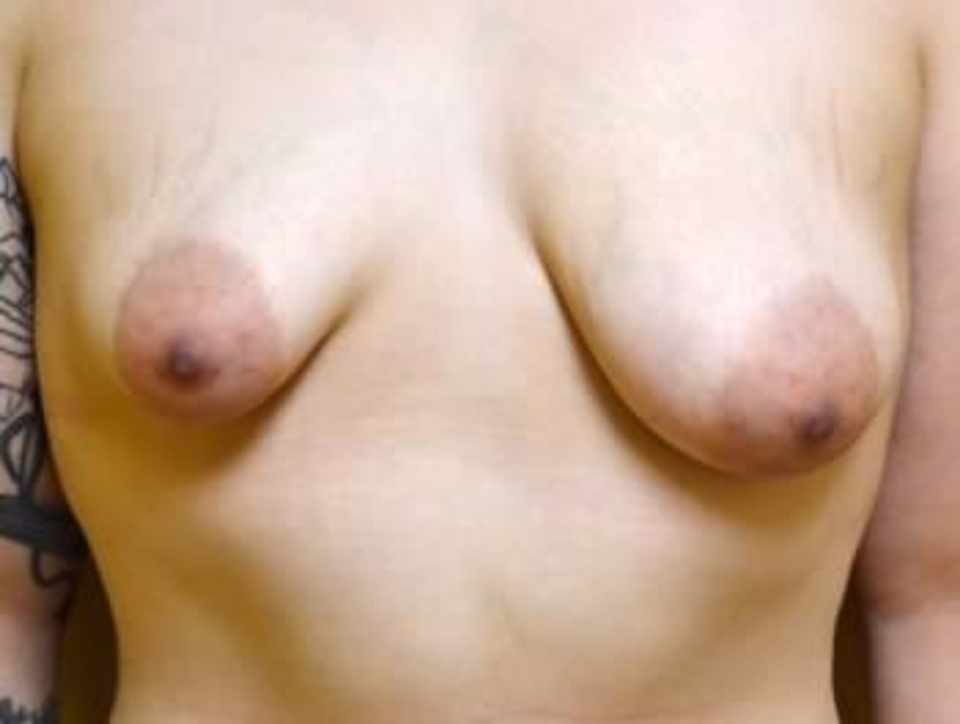 Breast Augmentation with Deformity