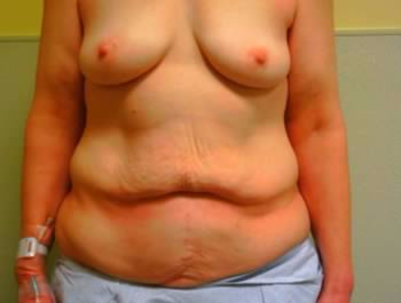 Breast Augmentation and Tummy Tuck