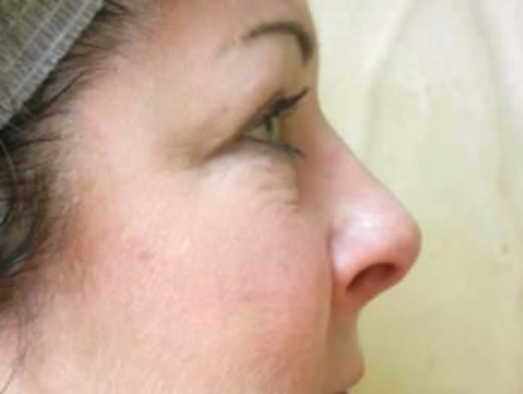 Upper & Lower Lid Blepharoplasty and Photofacial