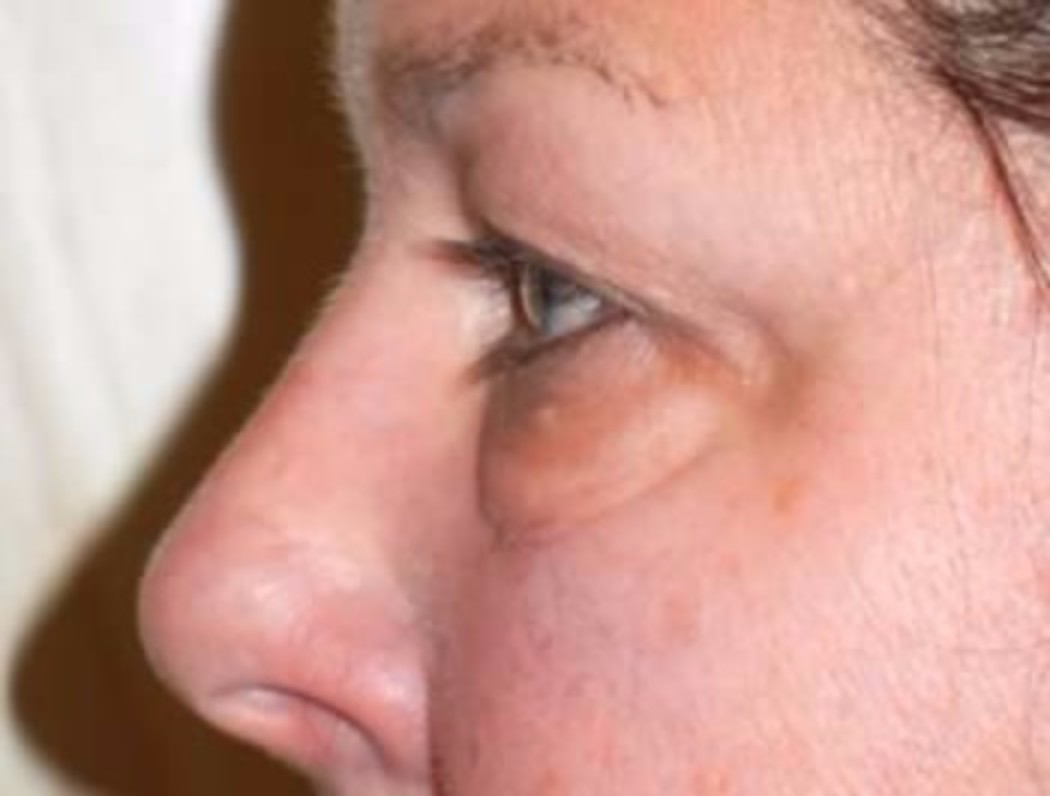 Upper & Lower Lid Blepharoplasty and Photofacial