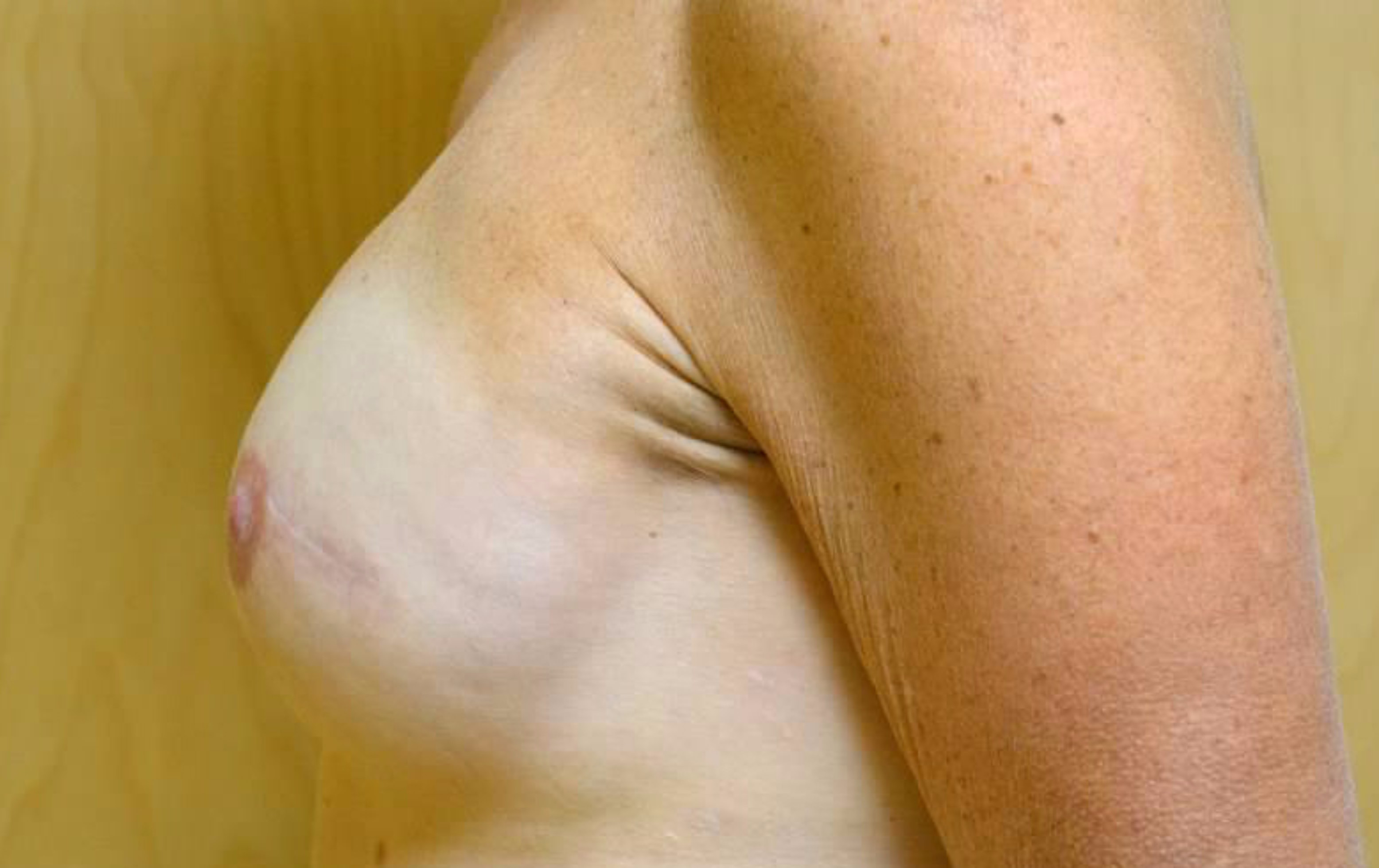 Rhode Island breast reconstruction before and after