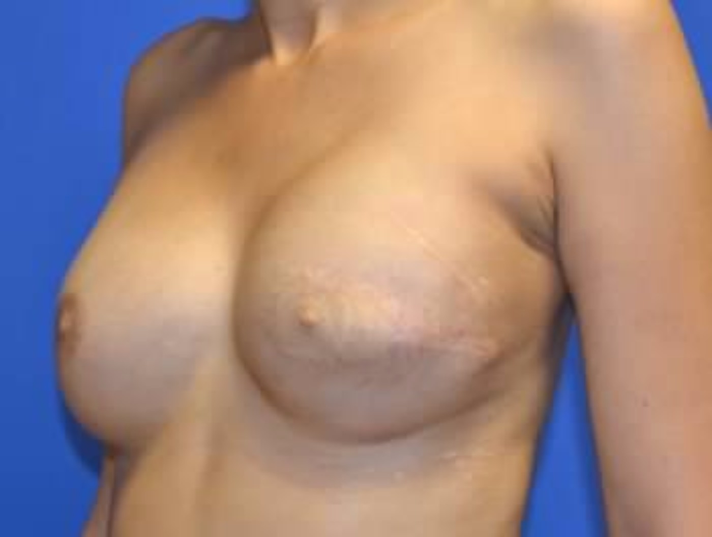 Rhode Island breast reconstruction before and after