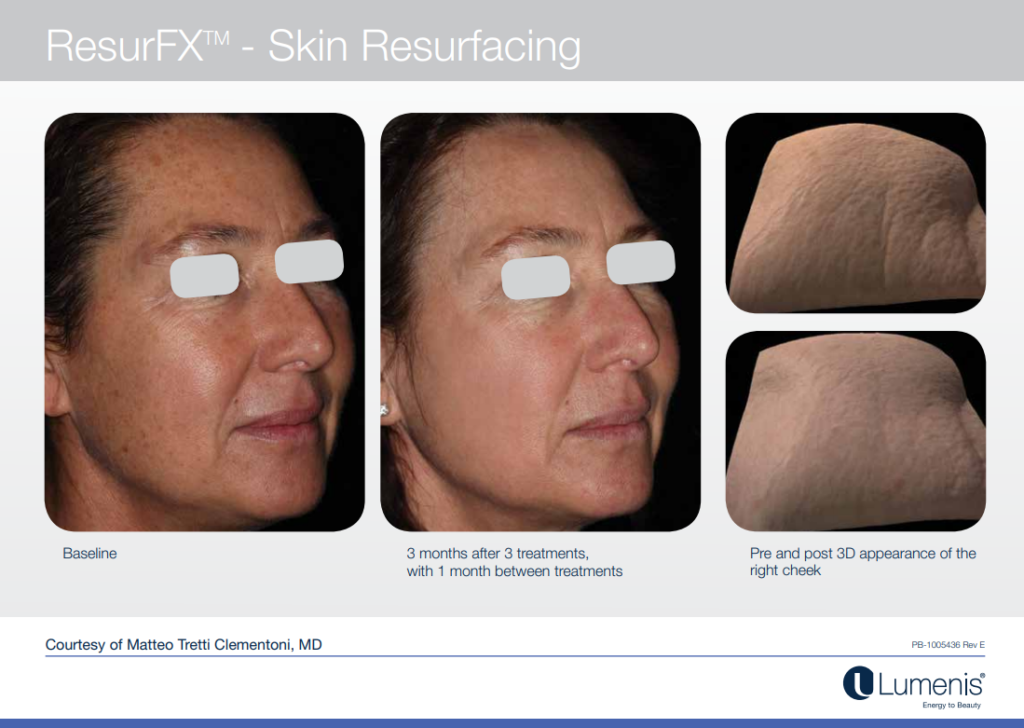 Before and after laser resurfacing with Lumenis M22 laser