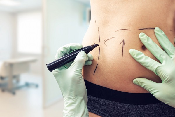 Can Liposuction Remove Belly Fat?