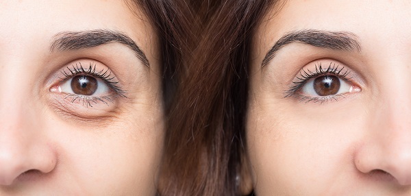 Woman,Eye,Before,And,After,Cosmetic,Treatment,With,And,Without