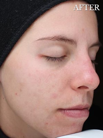 young woman with clear skin after chemical peel