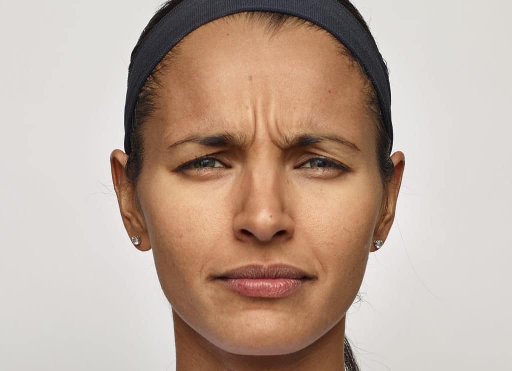 woman’s face before dysport, wrinkles on forehead