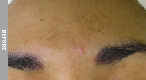 Hyperpigmentation Before 1