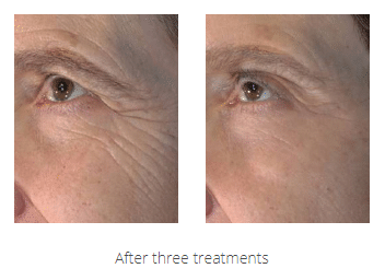 older patient's eye before and after vivace rf microneedling, fewer wrinkles after treatment