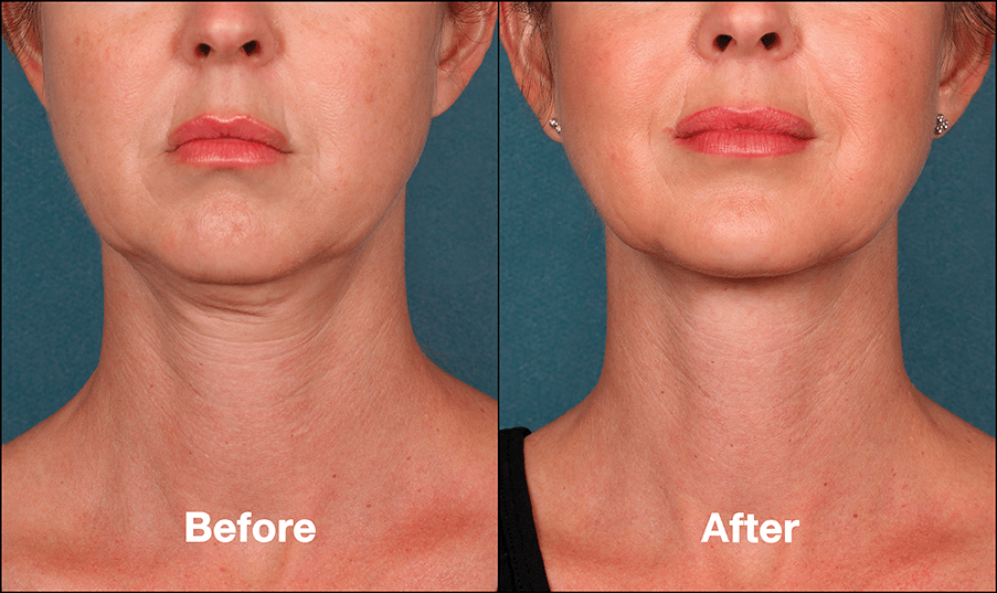 kybella before and after 1