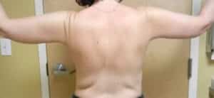 Arm Lift