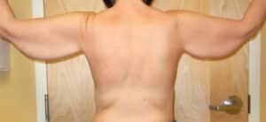Arm Lift