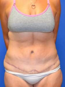 Tummy Tuck