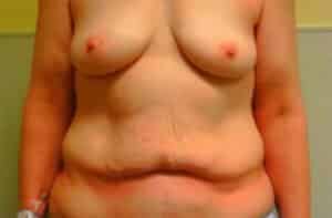 Breast Augmentation