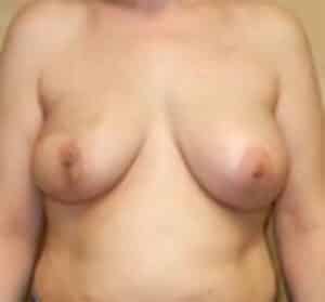 Breast Reconstruction