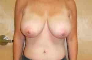 Breast Reduction