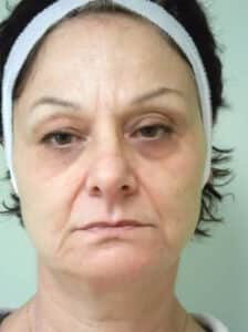 Before Image: Blepharoplasty