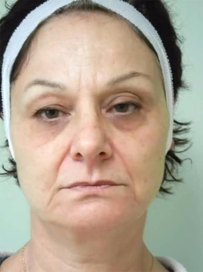 Before Image: Blepharoplasty - front