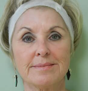 Fractional Non-Ablative Laser Resurfacing