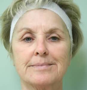 Fractional Non-Ablative Laser Resurfacing