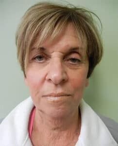 Juvederm Voluma Injection