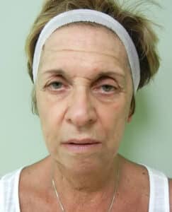 Juvederm Voluma Injection