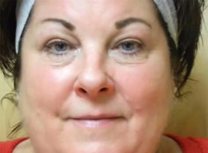 After Image: Blepharoplasty - front