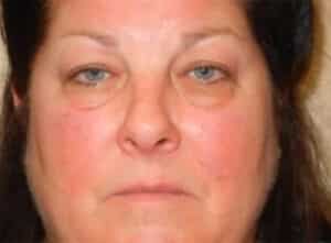 Before Image: Blepharoplasty