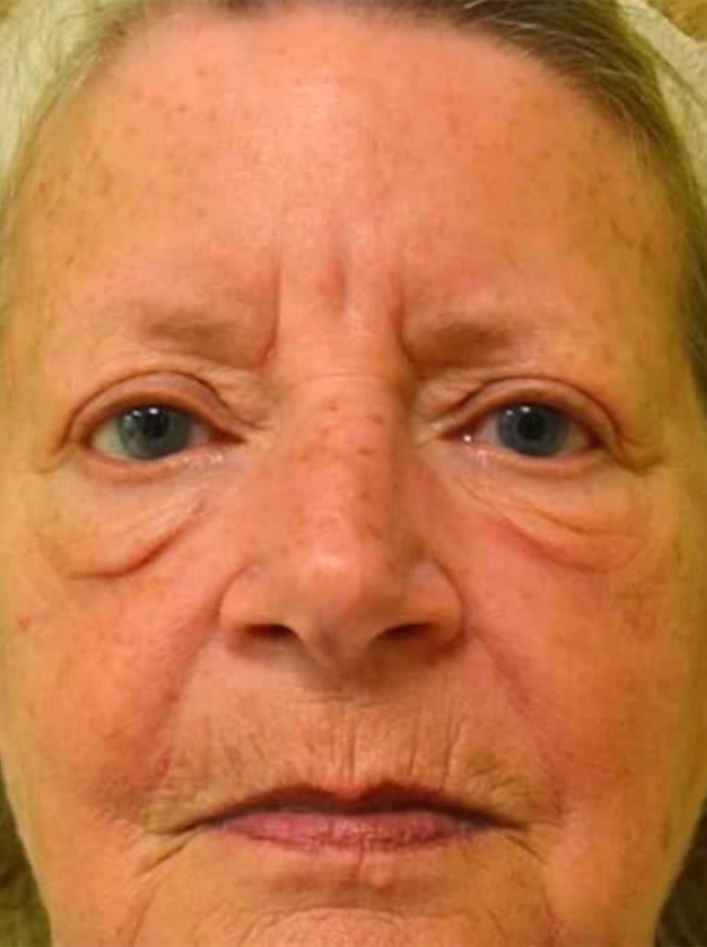 Before Image: Blepharoplasty - front