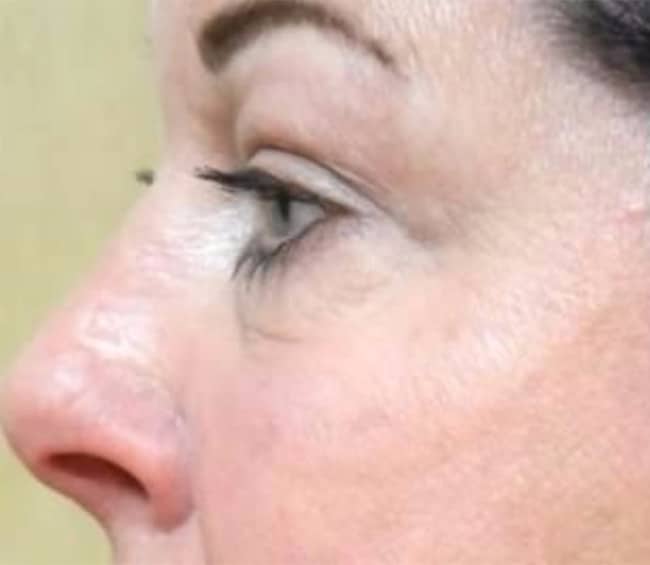 After Image: Blepharoplasty - left-side