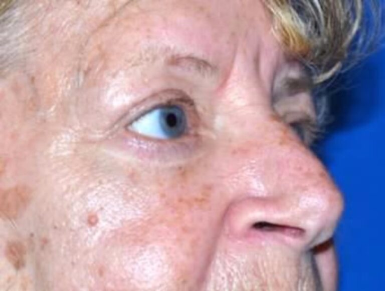 After Image: Blepharoplasty - right-front-oblique
