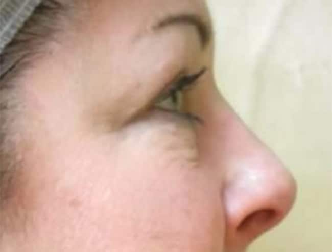 After Image: Blepharoplasty - right-side