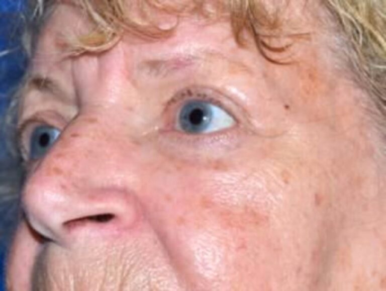 After Image: Blepharoplasty - left-front-oblique