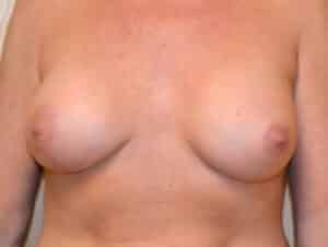 Breast Augmentation