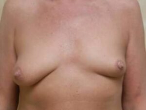 Breast Augmentation