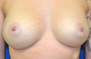 Breast Augmentation