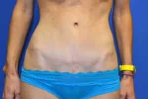 After Image: Tummy Tuck