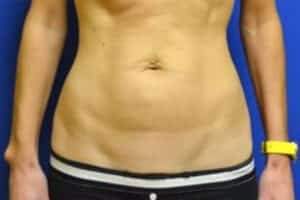 Tummy Tuck