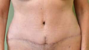 Tummy Tuck