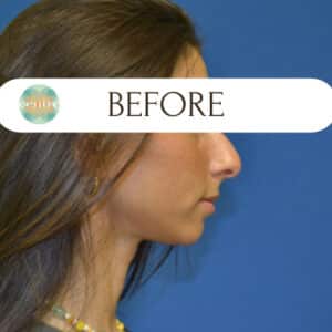 Liquid Rhinoplasty