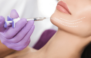 Kybella® treatment