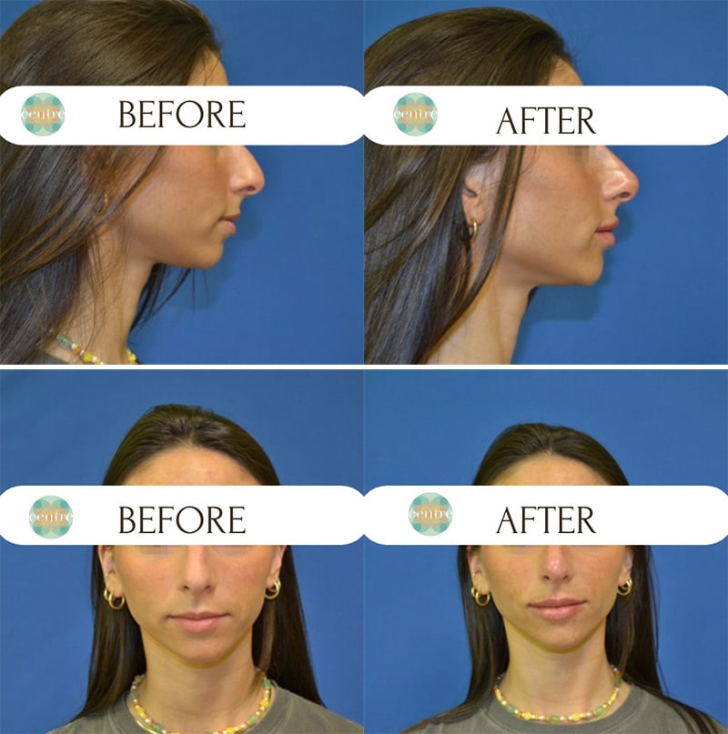 Liquid Rhinoplasty Featured Case