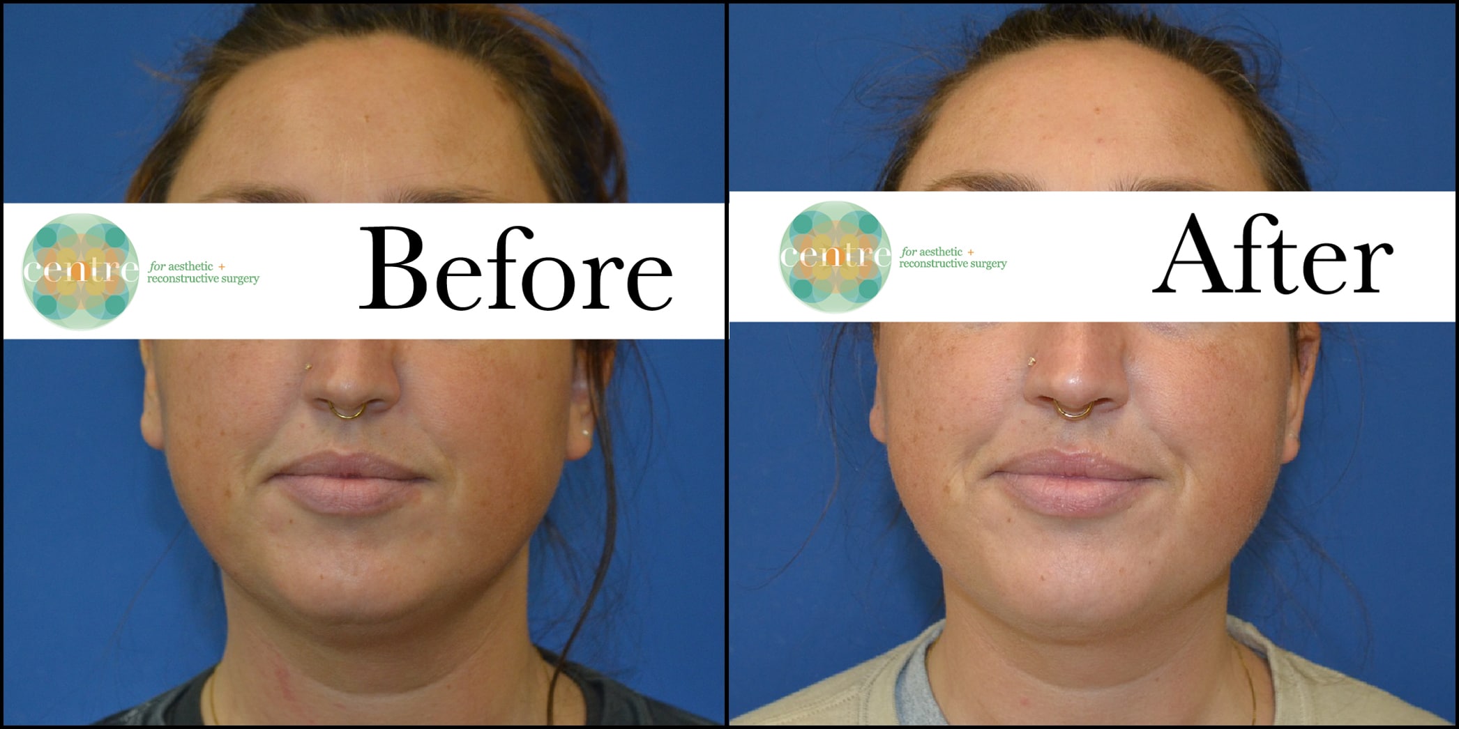 70302 Kybella Front Before and After
