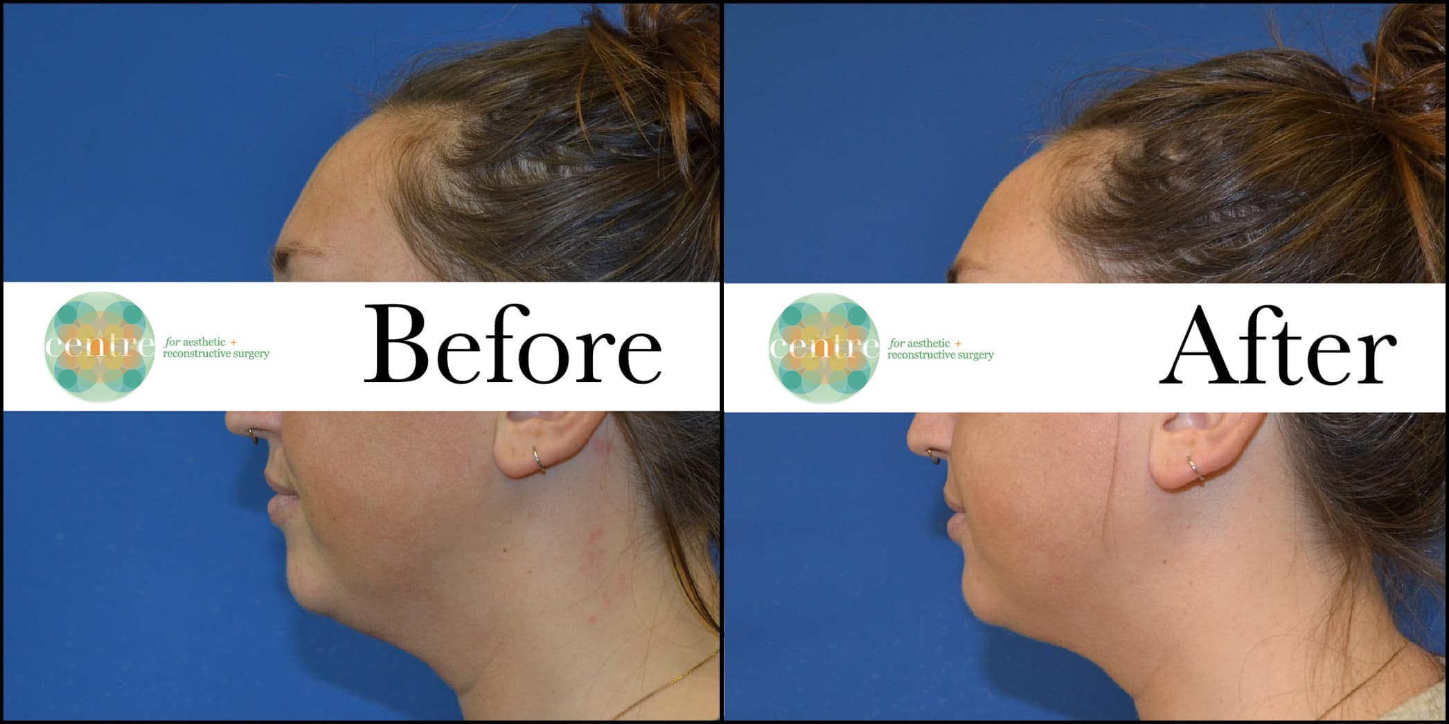 70302 Kybella Lateral Left Before and After