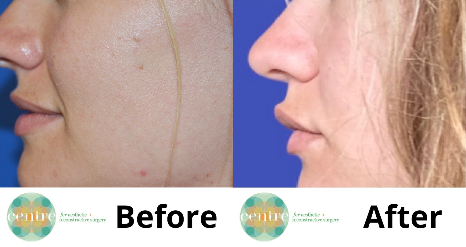 side view of woman's lips before and after lip flip with fuller upper lip after treatment